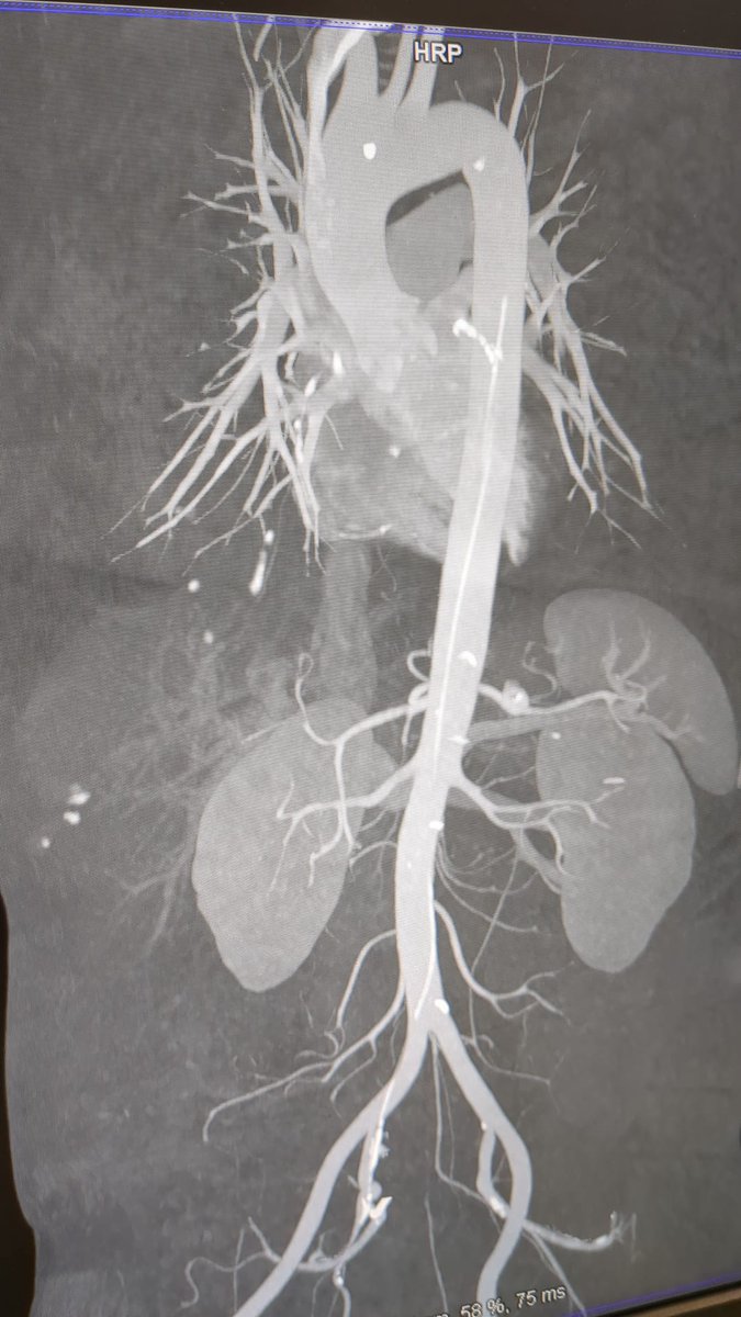 Elad Asher (@asherelad) on Twitter photo Coronary guidewire from 2012 (10 years ago), that was left (stuck) in the aorta. The patient was a symptomatic. An incidental finding...
<a href="/PCRonline/">PCRonline 🫀</a> <a href="/Sbrugaletta/">Salvatore Brugaletta</a> <a href="/Ortega_Paz/">Luis Ortega Paz</a> <a href="/aayshacader/">Aaysha Cader</a> <a href="/Anazmicalik/">A.Nazmi Calik</a> <a href="/guilbom/">Guilherme Ribeiro</a> <a href="/hect2701/">Prof. Hector M. Garcia-Garcia</a> <a href="/NicolaRyanI1/">Nicola Ryan</a> <a href="/DrPascalMeier/">Pascal Meier,MD</a> <a href="/W_jyg/">DrPatWJyg</a> <a href="/ICigalini/">Ignacio Cigalini 🇦🇷</a> Coronary guidewire from 2012 (10 years ago), that was left (stuck) in the aorta. The patient was a symptomatic. An incidental finding...
<a href="/PCRonline/">PCRonline 🫀</a> <a href="/Sbrugaletta/">Salvatore Brugaletta</a> <a href="/Ortega_Paz/">Luis Ortega Paz</a> <a href="/aayshacader/">Aaysha Cader</a> <a href="/Anazmicalik/">A.Nazmi Calik</a> <a href="/guilbom/">Guilherme Ribeiro</a> <a href="/hect2701/">Prof. Hector M. Garcia-Garcia</a> <a href="/NicolaRyanI1/">Nicola Ryan</a> <a href="/DrPascalMeier/">Pascal Meier,MD</a> <a href="/W_jyg/">DrPatWJyg</a> <a href="/ICigalini/">Ignacio Cigalini 🇦🇷</a>