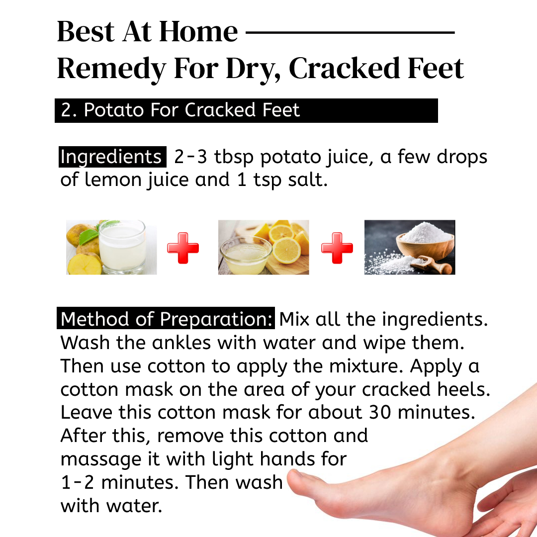 Home Remedies For Cracked Heels: Treatment, Causes & Prevention