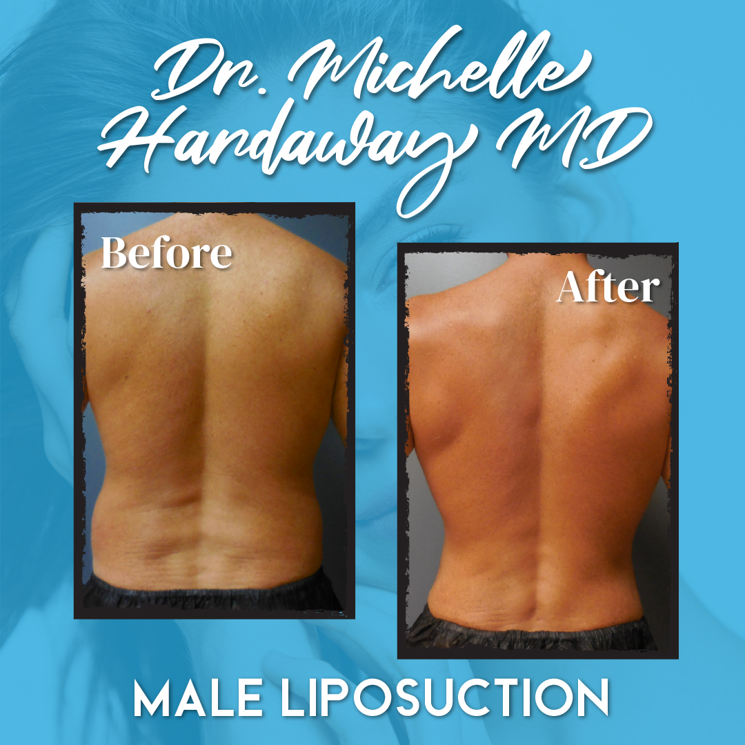 MichelleHMD's tweet photo. Before and after of a 44-year-old patient who underwent male vaser liposuction. After photo was 10 months post-op. 🤩
https://t.co/hoWjpcrkha
.
.
.
#cosmeticsurgery #plasticsurgery #liposuction #lipo #beforeandafter #surgery #maleliposuction #aestheticsurgery #vaserliposuction https://t.co/ttj7c5zgrC
