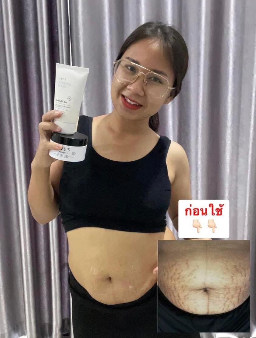 Eves_th's tweet photo. มายด์พิสูจน์แล้วว่ามันดีขึ้นได้ 👍🏻✨

รอยแตกลายจากสีเข้มๆ เริ่มจางลงเรื่อยๆ 
สามารถใช้ได้ทั้งตัว ให้ผิวชุ่มชื้น กระจ่างใส
คนที่กำลังท้องแล้วไม่อยากให้ท้องแตกลาย
เริ่มทาเลยนะคะ 

#อีฟส์ออยล์ #บูสเตอร์อีฟส์
#อีฟส์แตกลายหายเรียบ
#ถ้าท้องต้องอีฟส์
#รีวิวจากผู้ใช้eves
#EVES https://t.co/4PQVHkszCD