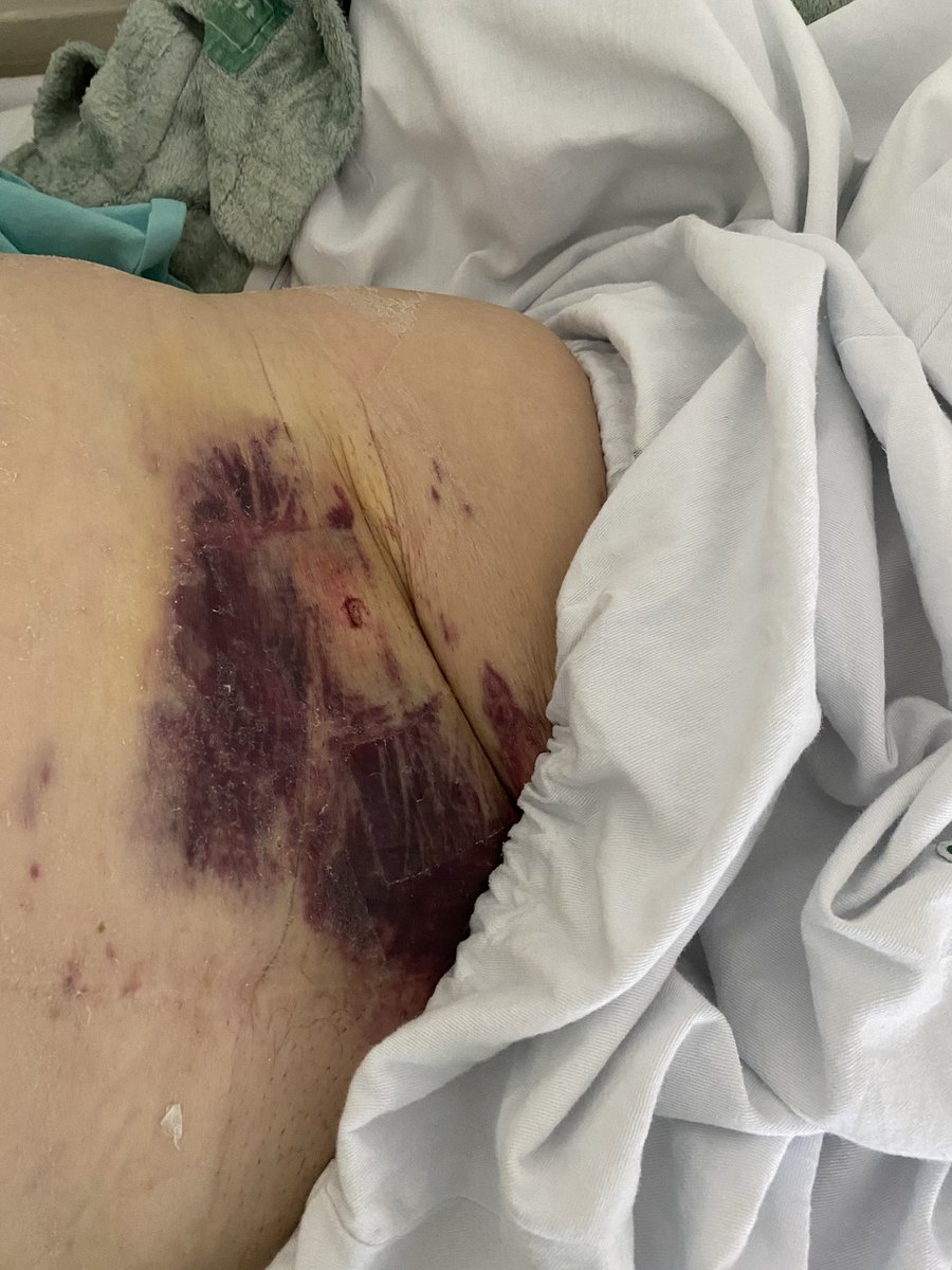 dimitri_zappi's tweet photo. It’s all about learning curve, resources that you have and wisdom to choose when to choice #dTRafirst instead #RadialFirst. If you don't accept this, you have no choice, the 1️⃣st one is a post #TAVR patient and the 2️⃣nd one is a patient without ulnar and radial pulses. https://t.co/ubJfBduAng