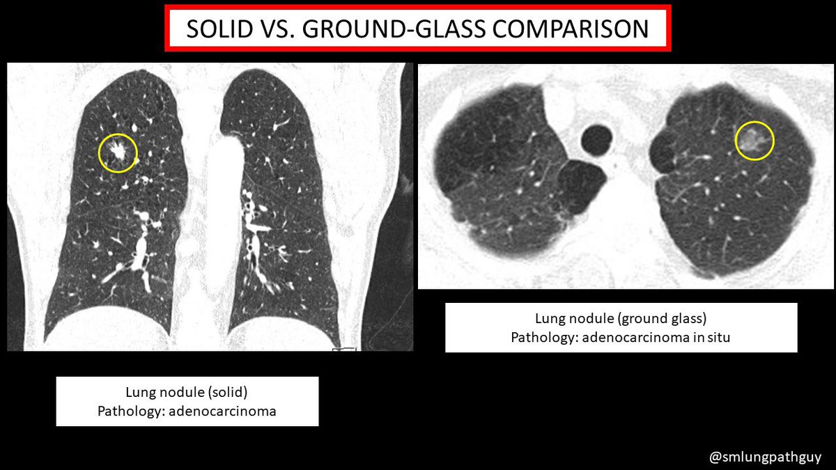 I made these slides to explain ground-glass opacities and ground-glass lung nodules to my medical students and residents. Please feel free to use them to teach yours. 🙏🏾 #pathology #pulmpath #radpath #imaging @howardm19 @TLHM_MD @leticiakawano