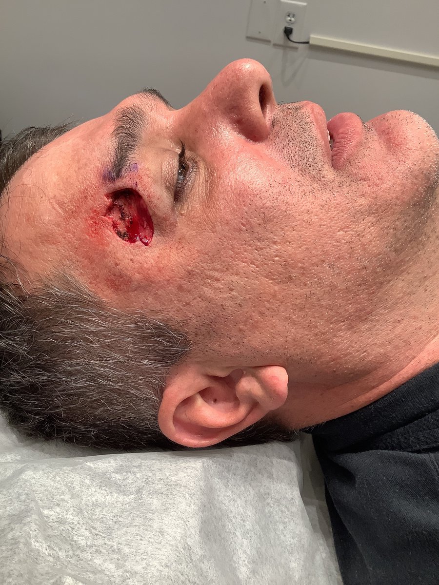 MohsCollege's tweet photo. Flap Friday Part One: A 45-year old man
presents with a basal cell carcinoma on the right
eyebrow. Mohs micrographic surgery was performed,
and the skin cancer was removed in 3 layers. The
patient was concerned about any eyelid pull. How
would you repair this? #flapfriday https://t.co/CsyrbUn8zH