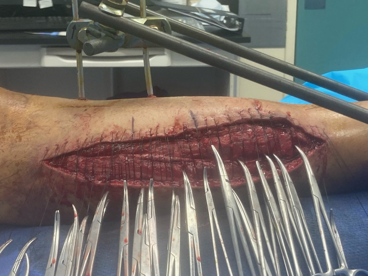 erikmayermd's tweet photo. @InvictaOrtho For my tough closures I prefer using multiple Allgöwer-Donati sutures, thrown loose, then snapped to a hemostat and tightened sequentially. https://t.co/wsu8HQ19gr