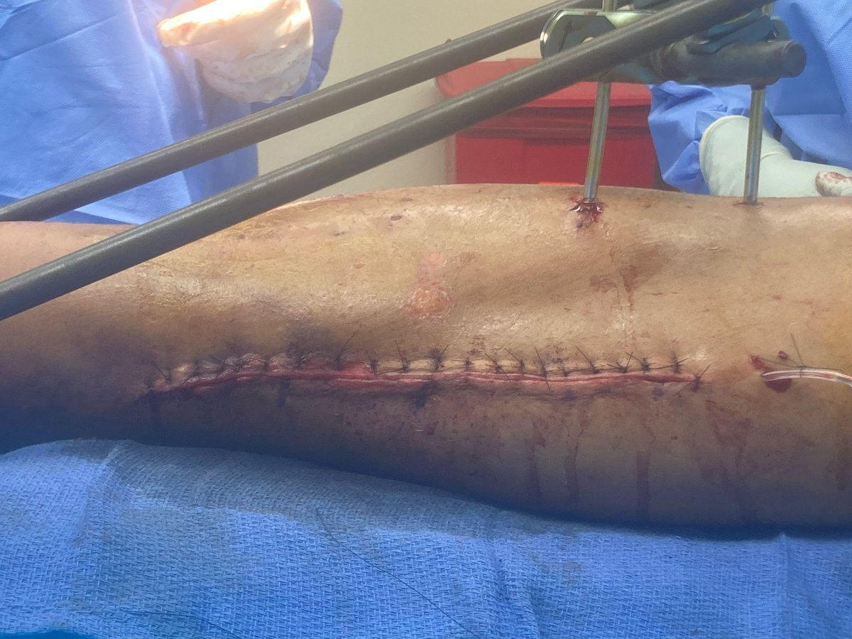 erikmayermd's tweet photo. @InvictaOrtho For my tough closures I prefer using multiple Allgöwer-Donati sutures, thrown loose, then snapped to a hemostat and tightened sequentially. https://t.co/wsu8HQ19gr