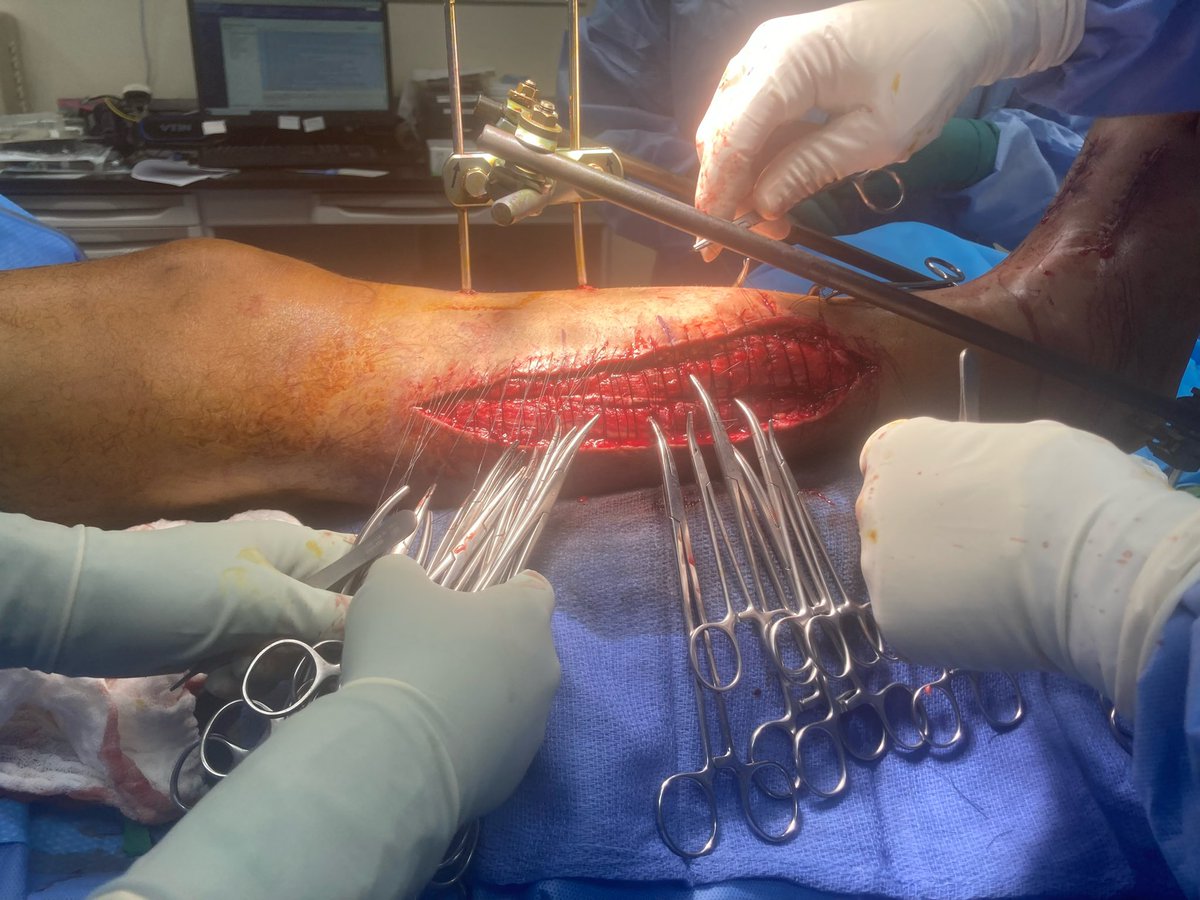 erikmayermd's tweet photo. @InvictaOrtho For my tough closures I prefer using multiple Allgöwer-Donati sutures, thrown loose, then snapped to a hemostat and tightened sequentially. https://t.co/wsu8HQ19gr