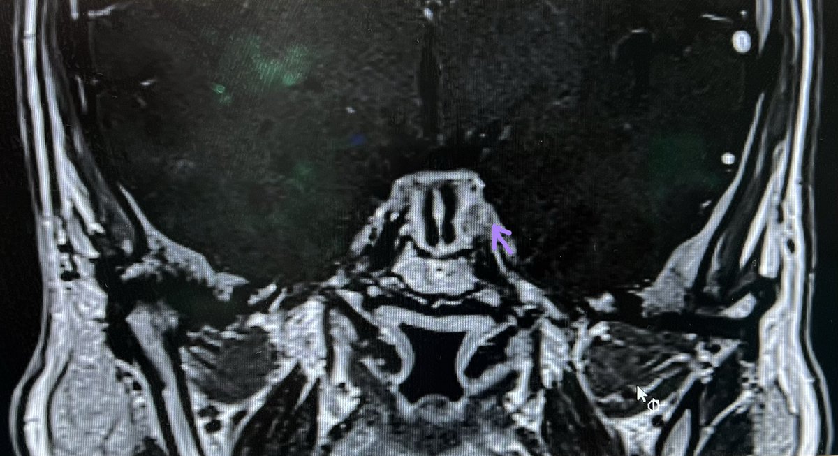 LauraB_Lopez's tweet photo. Acromegaly patient with multiple hypointense nodules on T1 post-contrast MRI and hypoplastic diaphragma sellae. IntraOp images showing extracapsular dissection. #HUMS #EES @aaerre https://t.co/bBaRW2fLwu
