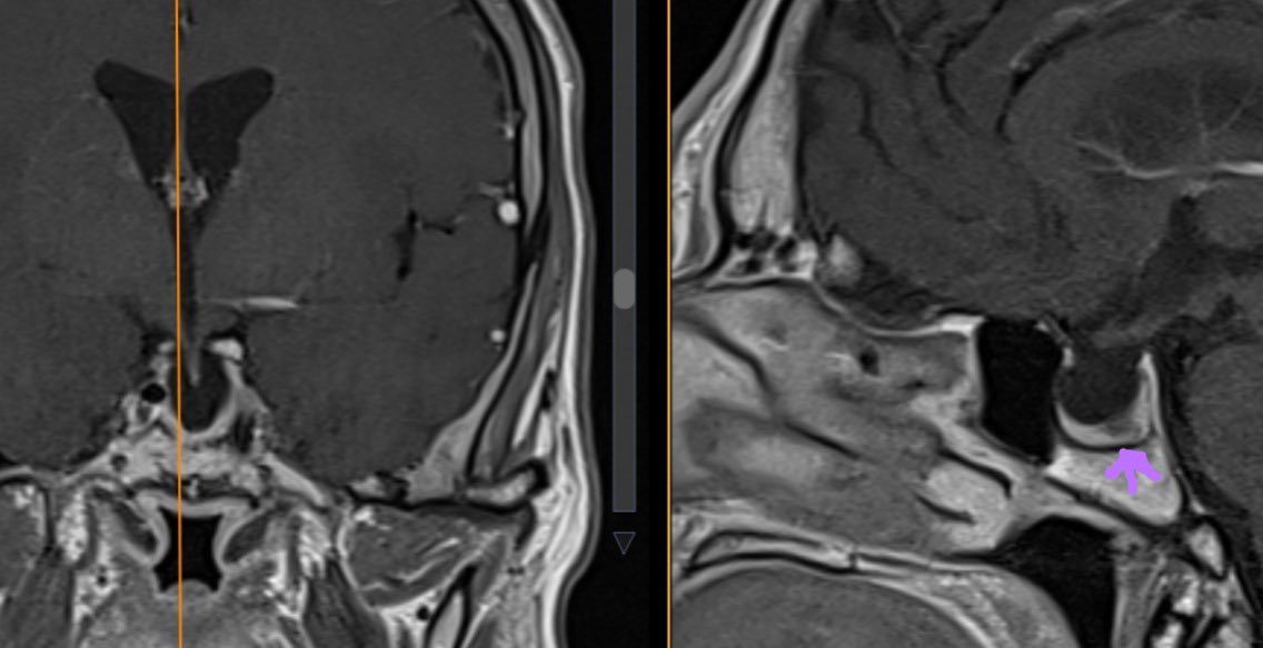 LauraB_Lopez's tweet photo. Acromegaly patient with multiple hypointense nodules on T1 post-contrast MRI and hypoplastic diaphragma sellae. IntraOp images showing extracapsular dissection. #HUMS #EES @aaerre https://t.co/bBaRW2fLwu