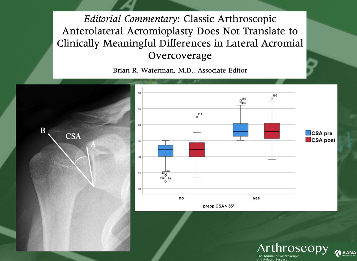 <a href="/H2O_SportsMD/">Brian Waterman, MD</a> with his commentary on the clinical usefulness of classic anterolateral acromioplasty vs. lateral acromioplasty in cases of RTC tears with an increased critical shoulder angle. ow.ly/MS6550LGcgt