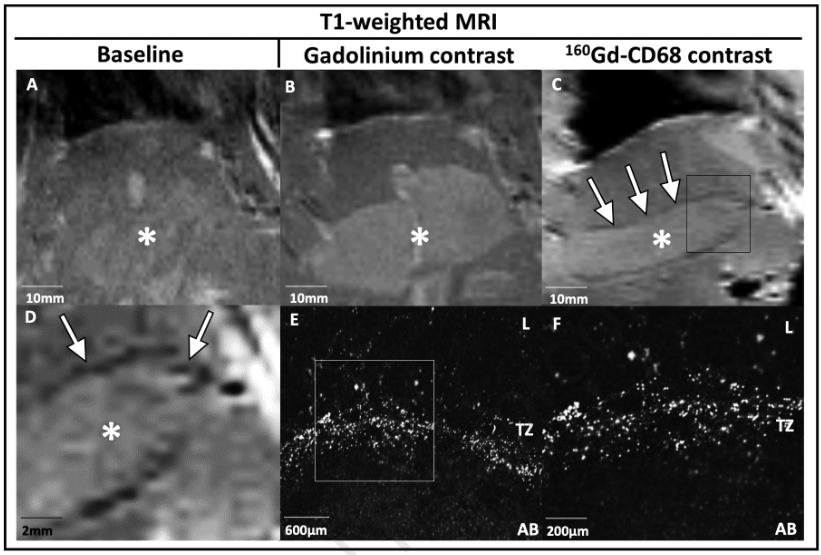 JuliusChapiro's tweet photo. Immensely proud to publish this work in @JVIRmedia, establishing non-invasive imaging of immune cells in the peri-ablational zone following  liver ablation. While a technical study, it's a first in mouse models, 9.4T scanner, with nano-probes pharmacodynamics. More to come! #irad https://t.co/DkMR80zJ6O