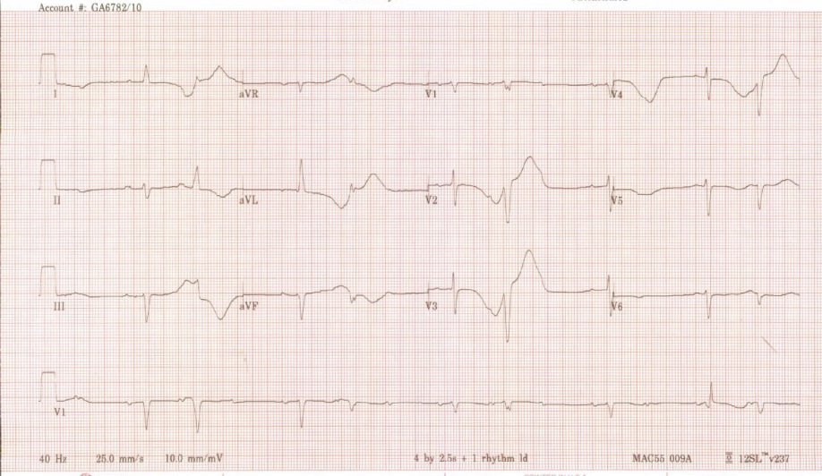 Syncope. Likely cause? #EPeeps  #Cardiologyfellows
@EPeeps_Bot