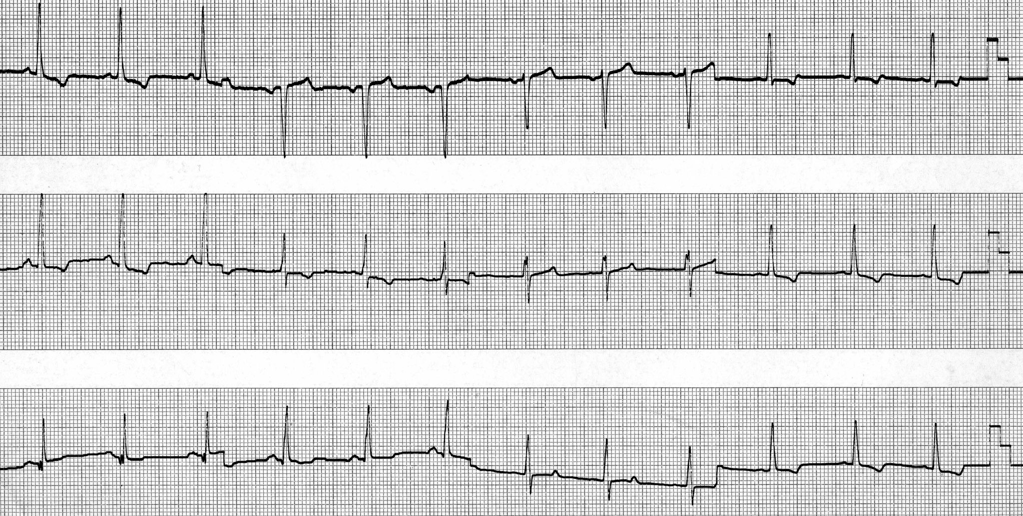 Philip J Podrid MD on Twitter "ECG for week. Hope your brain waves are