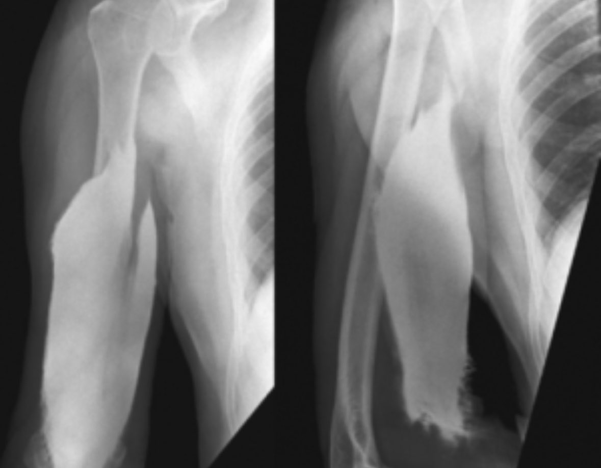 radRounds Radiology Network on Twitter "Severe pain in arm after 