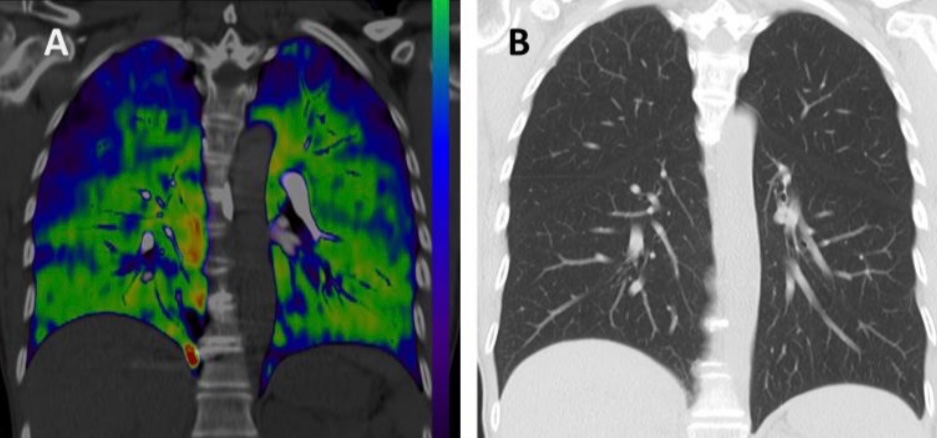 Breathless patients with long COVID often have isolated low DLCO with normal lung volumes, and impaired DECT-derived perfusion
Early release here openres.ersjournals.com/content/erjor/…