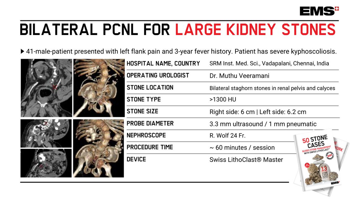 EMSUrology's tweet photo. A truly exceptional PCNL case for a patient with severe kyphoscoliosis. Can you imagine performing this surgery? 😮 

Watch the full video here: https://t.co/Iy3mbzgT9W

Thank you, Dr. Muthu Veeramani, for this case for our new eBook!

#IlovePCNL #LithoClast https://t.co/77hI9A7f4Z