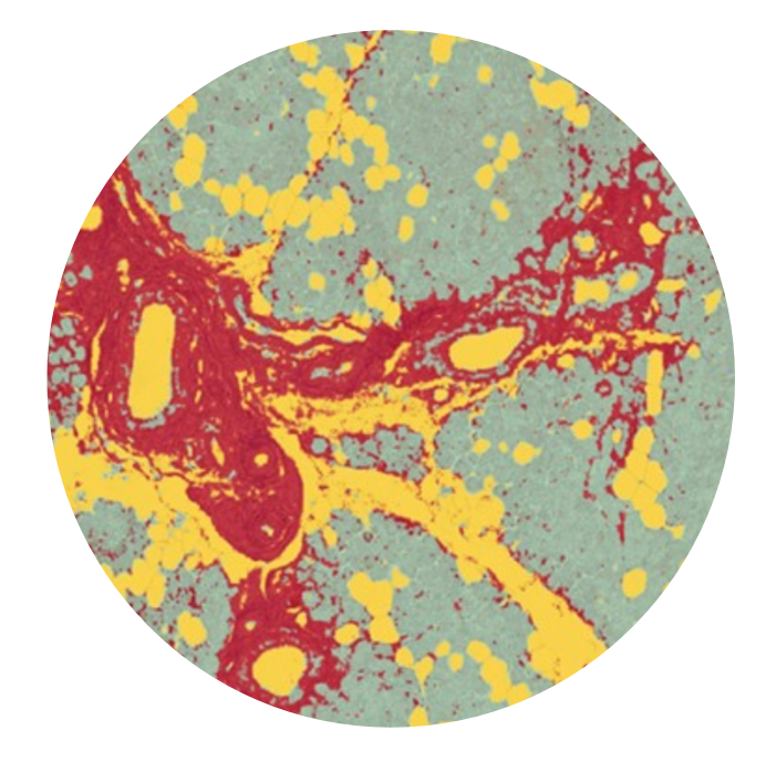 RheumJnl's tweet photo. #RheumOff Round Two!
1️⃣ Safranin O–Fast Green and H&E staining of knee cartilage from DMM mice https://t.co/HsnIEGRILF by Liangliang Liu et al
2️⃣ (Immuno-)histological analysis of parotid gland tissue from pSS patient https://t.co/YCeFEbTJTz by Esther Mossel et al
Continued👇 https://t.co/MQOVlwf18P