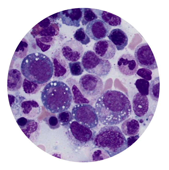 RheumJnl's tweet photo. #RheumOff Round Two! Vote for the cover of Rheumatology Vol 62!
3️⃣ Bone marrow aspirate from patient with VEXAS syndrome https://t.co/gcOmpBt4F0 by @Ertugrul_cagri @petercgrayson et al
4️⃣ The HE staining of tophus https://t.co/fLE8eHzbG3 by Li Zhao et al
Poll below👇 https://t.co/aUziA5ddED