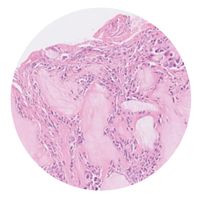 RheumJnl's tweet photo. #RheumOff Round Two! Vote for the cover of Rheumatology Vol 62!
3️⃣ Bone marrow aspirate from patient with VEXAS syndrome https://t.co/gcOmpBt4F0 by @Ertugrul_cagri @petercgrayson et al
4️⃣ The HE staining of tophus https://t.co/fLE8eHzbG3 by Li Zhao et al
Poll below👇 https://t.co/aUziA5ddED