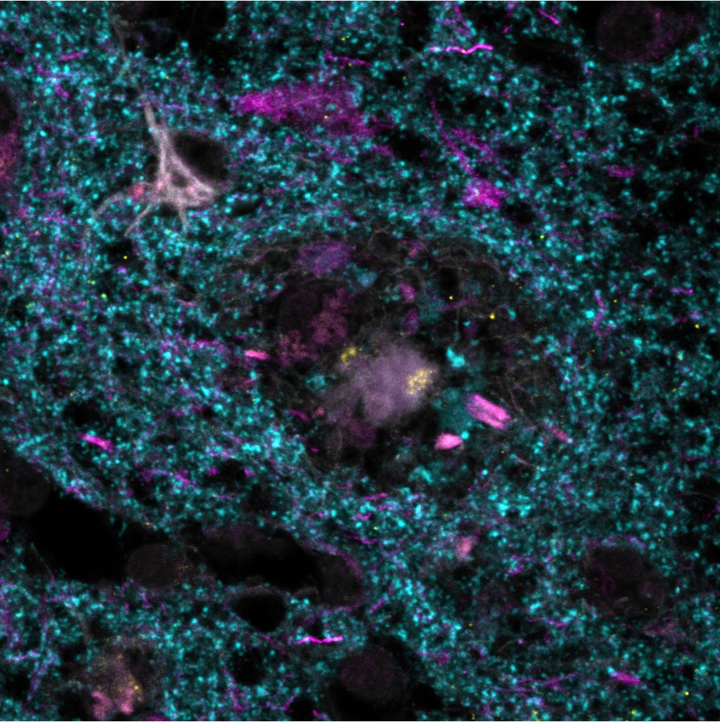 Is this a galaxy of stars or a network of neurons in our brain?🧠

We are funding vital equipment for scientists like @TSpiresJones to peer into the biological processes of the diseases that cause dementia. 🔬

#ARUKImageoftheWeek