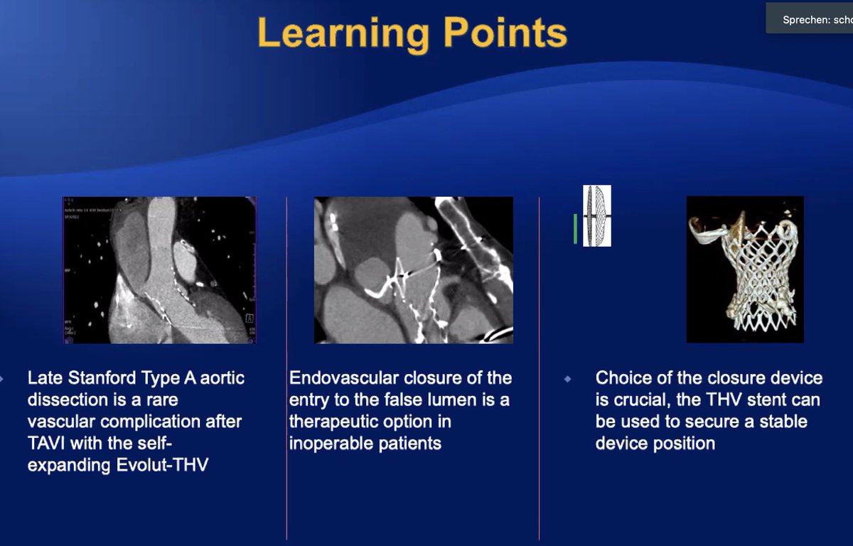MonteHeart's tweet photo. ⭐️Prof Schofer at #CathConference w/moderator @azeemlatib: 3 structural cases,challenging even for a master #IC
1️⃣TAAo dissect 5M p/Evolut➡️Ampl PFO occluder
2️⃣TR+PVL p/surg Ring➡️Sapien ViR&Plug
3️⃣MR from slit AML➡️closure incomplete (VSD/PFO/ASD devices in⬆️⬆️ pressure PVL?) https://t.co/DllgaaPHGE