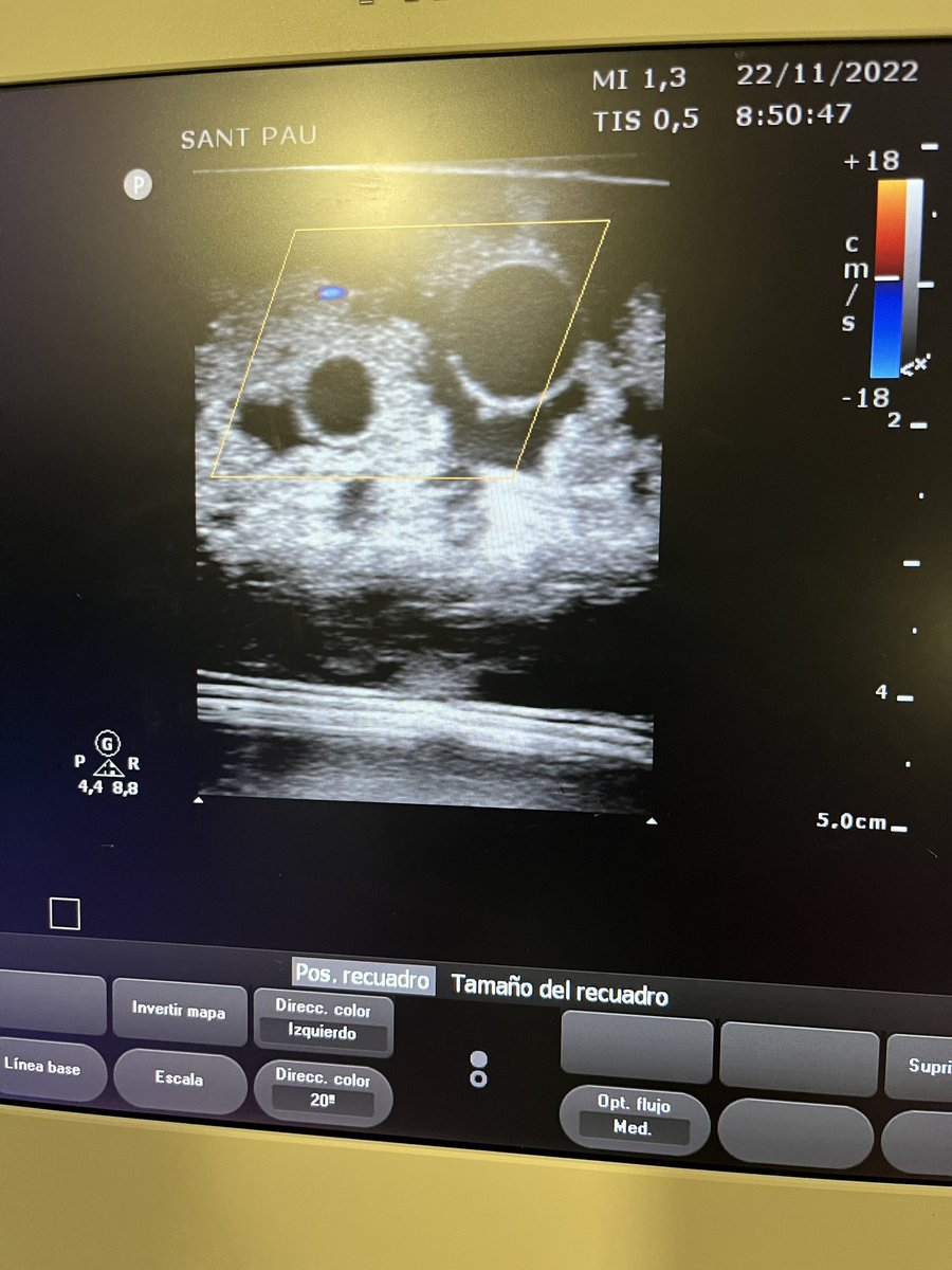sionis_a's tweet photo. Take a look at our homemade echo-guided vascular access phantom! Put in practice what you have learned at ACVC School 2022! #escacvc #acvcpresident #esc https://t.co/a5h3PpGQVX