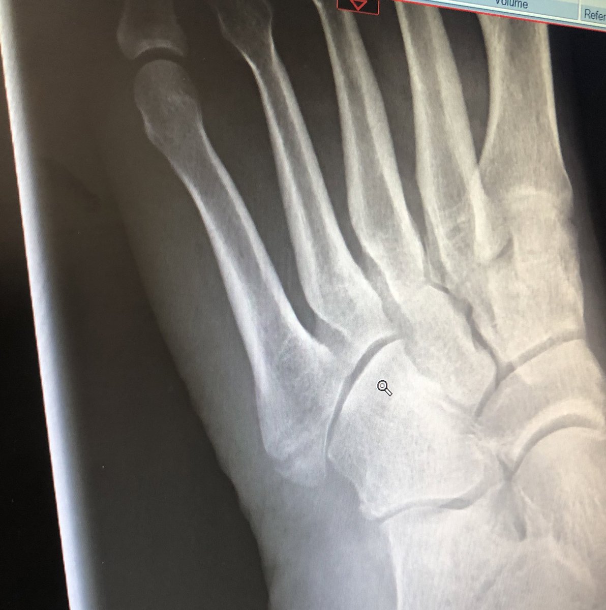 PeteMatthews19's tweet photo. Back into the boot I go for 6 weeks…😞 https://t.co/Im28M0gGXP