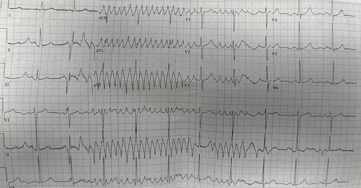 Hi Everyone- Friendly reminder that this is artifact and not VT. #EPeeps