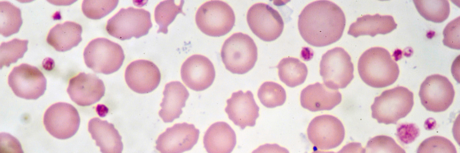 ASGCTherapy's tweet photo. Today, the FDA approved the FIRST #genetherapy to treat adults with Hemophilia B—#Hemgenix (etranacogene dezaparvovec)! Learn more about the treatment from ASGCT President @HPKiem, MD, PhD: https://t.co/5pARmY3EPg. https://t.co/pBqsiKQL7U