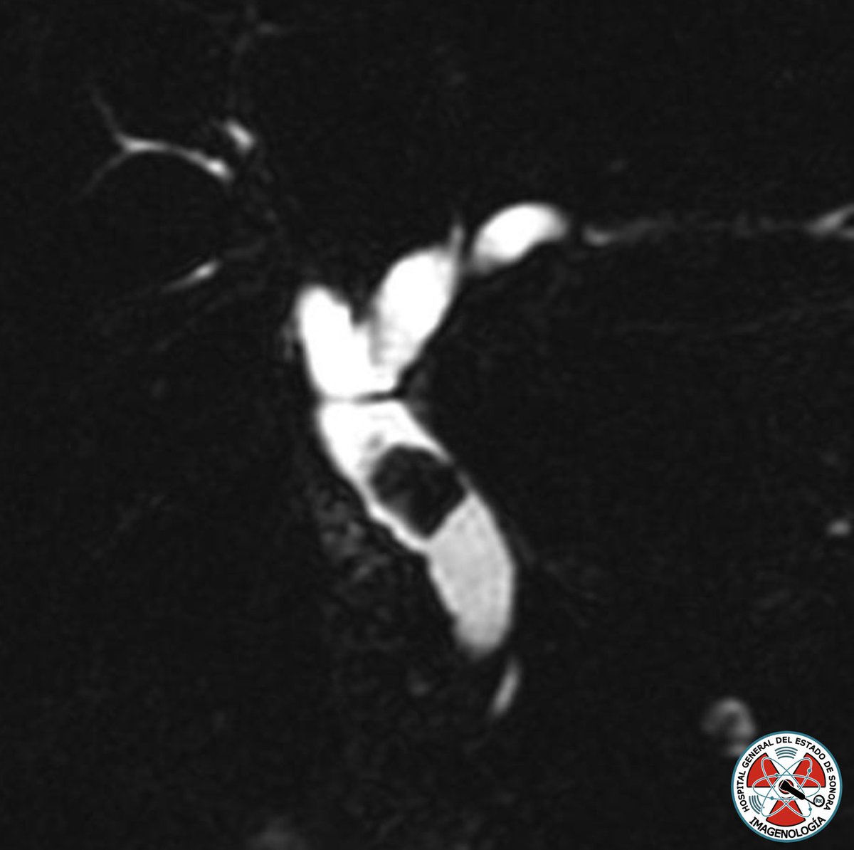 ¿Cuál es tu impresión diagnóstica? #radiology #radres <a href="/XochitlMadrid1/">Fernanda Madrid</a>