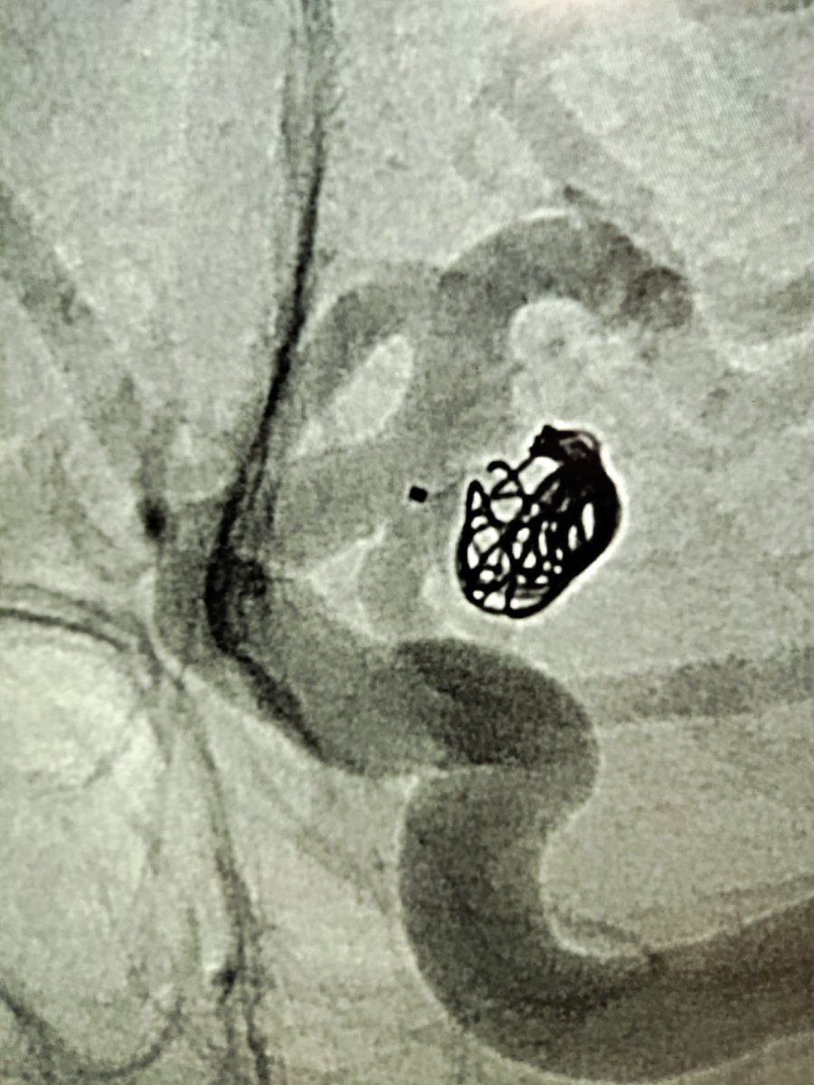 Case of the day. Fetal PcomA aneurysm. Endovascular treatment, jailing with Contour intrasacular device + coils. #neuroradiology #endovascular #aneurysm #embolization #intrasacular