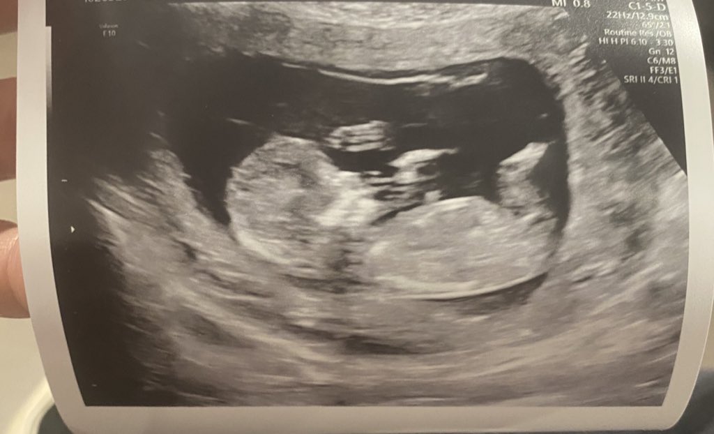 Hey it’s been 16 weeks! 
For anyone who cares, this will be 
Aiden Michael Wilt.  🤘🤘🤘