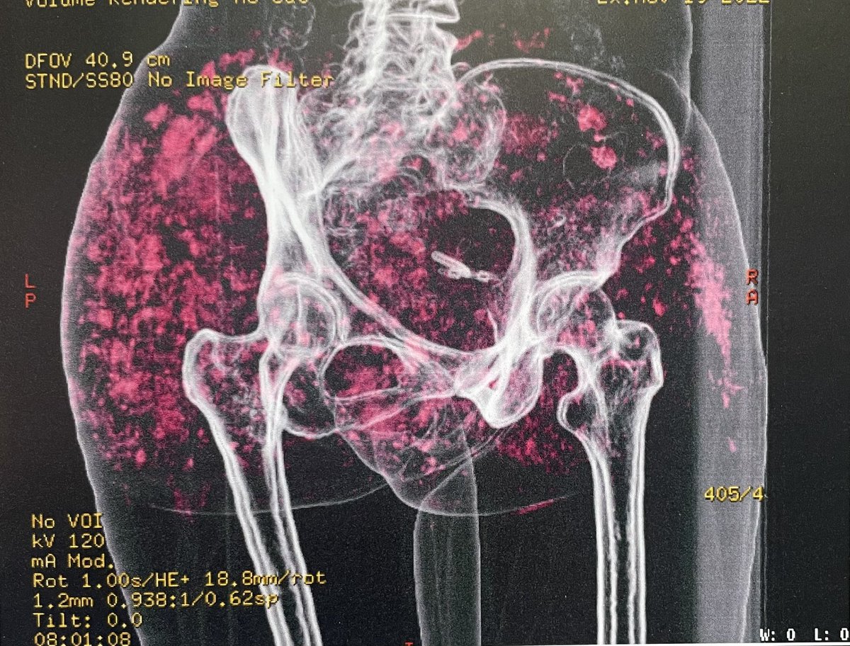 hertozu's tweet photo. Los mortales y muy peligrosos Biopolimeros !!
Cuidado NO usar esto y no se dejen engañar de inyecciones para aumentar los glúteos #morbility #mortality https://t.co/bhiVaHQlNS