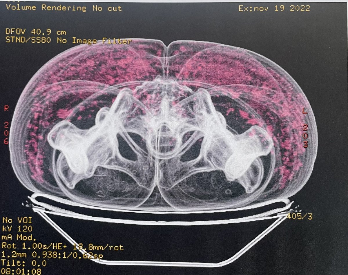 hertozu's tweet photo. Los mortales y muy peligrosos Biopolimeros !!
Cuidado NO usar esto y no se dejen engañar de inyecciones para aumentar los glúteos #morbility #mortality https://t.co/bhiVaHQlNS