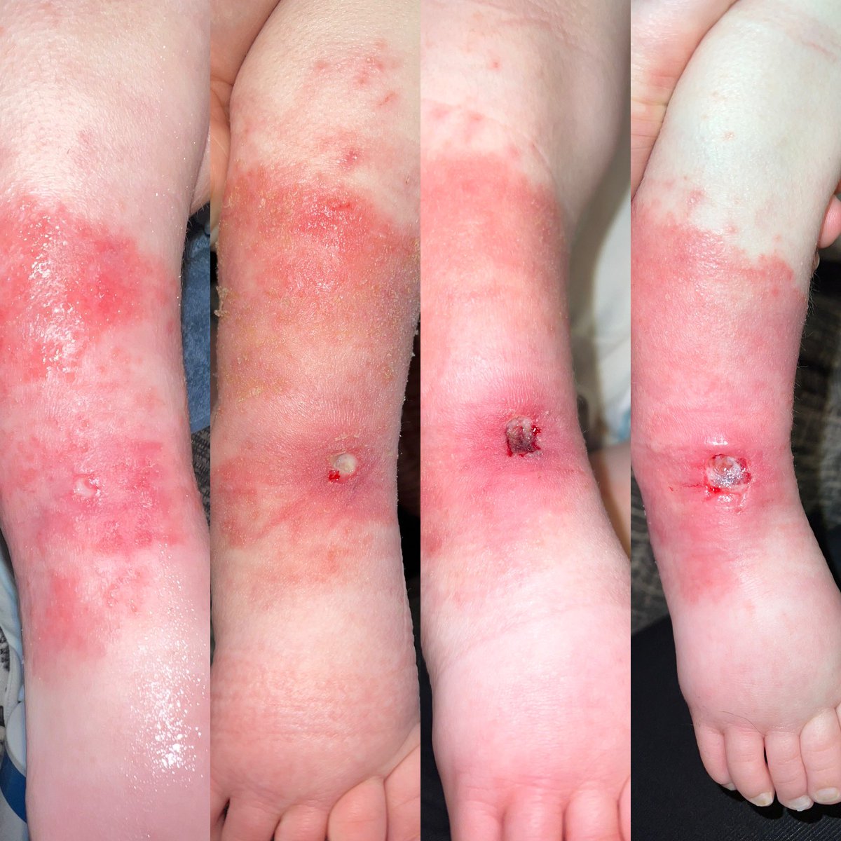 Rosiejolliffex's tweet photo. 30+ week wait for a dermatology referral after already waiting 20+ weeks. Neglect! The below pictures are a weeks deterioration in Alices eczema WITH GP treatment of daily dressings and antibiotics. She gotta lose her leg before shes seen? @aaroncumminsNHS @ChildrensFgh @UHMBT https://t.co/rRUKkuizJN