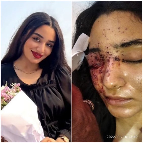 Bu genç kadının adı Gazal Ranjkesh; İran’ın Bandarabbas bölgesinden bir hukuk öğrencisi. İran rejim güçleri yakın mesafeden saçma atan tüfekle yüzüne ateş açtığı için sağ gözünü kaybetti. Gazal, “Sağ gözümün kaydettiği son görüntü silahı ateşleyen polisin gülüşüydü.” dedi…