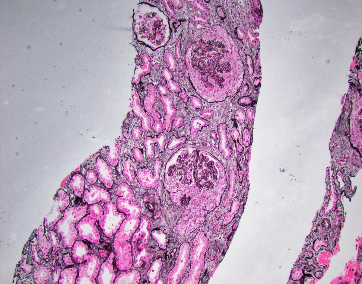 JZRenalPath's tweet photo. Rare case of bone fide crescentic IgA nephropathy (>60% cellular crescents). Occurs in ~5% of IgAN cases. Be sure to rule out ANCA in these cases as well. IF shows IgA staining. #renalpath #pathtwitter https://t.co/eFn1qeVWLJ