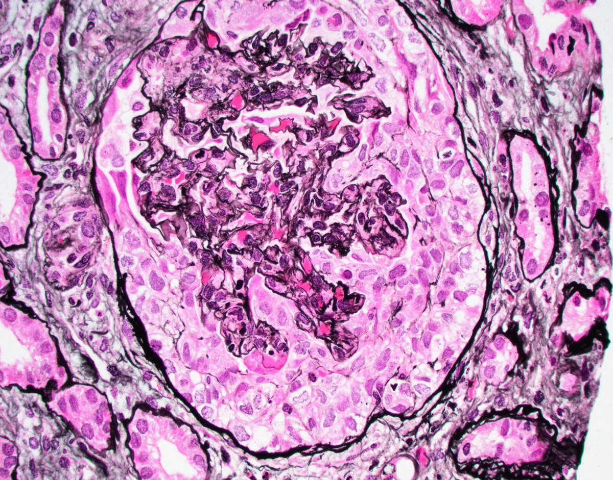 JZRenalPath's tweet photo. Rare case of bone fide crescentic IgA nephropathy (>60% cellular crescents). Occurs in ~5% of IgAN cases. Be sure to rule out ANCA in these cases as well. IF shows IgA staining. #renalpath #pathtwitter https://t.co/eFn1qeVWLJ