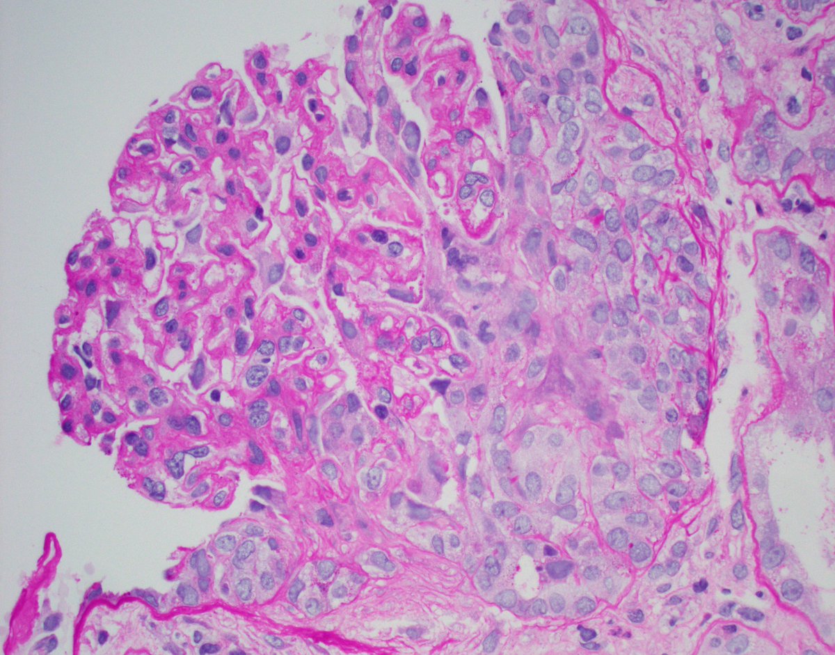 JZRenalPath's tweet photo. Rare case of bone fide crescentic IgA nephropathy (>60% cellular crescents). Occurs in ~5% of IgAN cases. Be sure to rule out ANCA in these cases as well. IF shows IgA staining. #renalpath #pathtwitter https://t.co/eFn1qeVWLJ