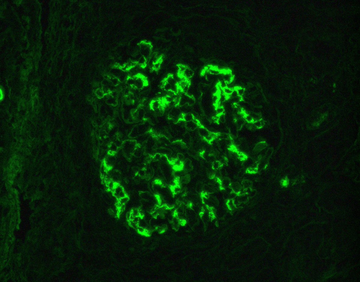 JZRenalPath's tweet photo. Rare case of bone fide crescentic IgA nephropathy (>60% cellular crescents). Occurs in ~5% of IgAN cases. Be sure to rule out ANCA in these cases as well. IF shows IgA staining. #renalpath #pathtwitter https://t.co/eFn1qeVWLJ