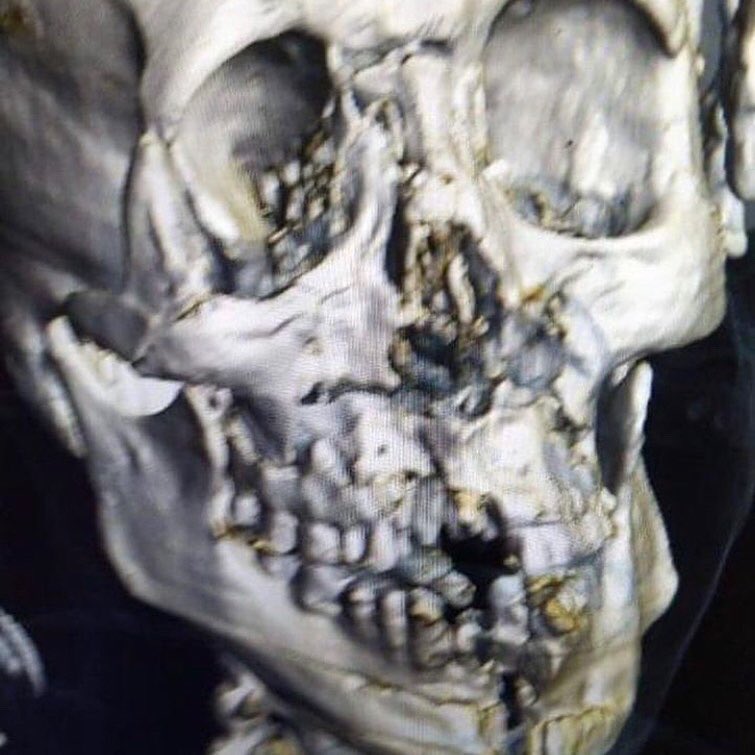 Escalofriante el golpe que se dio Yasser Al-Shahrani, jugador de #KSA que chocó con su arquero, Mohammed Alowais. Los medios árabes informan que tuvo que ser operado. 

Fractura de la mandíbula y huesos faciales izquierdos además de hemorragia interna luego del golpe.