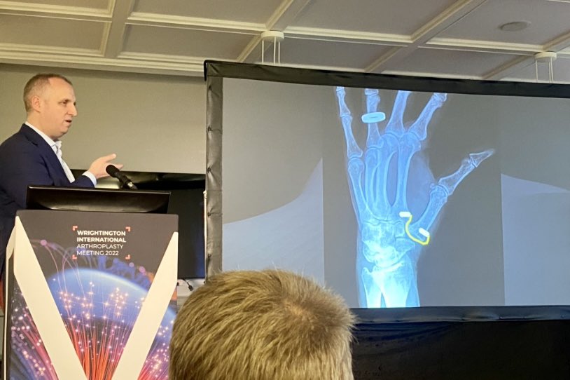 Kasia Studnicka-Perkin (@s2dnia) on Twitter photo Superb hand and wrist session at @WIAM22 on base of thumb OA spacers and arthroplasty options. Thanks to <a href="/mike_hayton/">Mike Hayton</a> <a href="/uplimb/">WULU</a> and @StrykerUK for bringing top faculty together. Olivier Mares, Philippe Bellmere, Tim Davis, <a href="/handprocedures/">Dan Armstrong</a> Superb hand and wrist session at @WIAM22 on base of thumb OA spacers and arthroplasty options. Thanks to <a href="/mike_hayton/">Mike Hayton</a> <a href="/uplimb/">WULU</a> and @StrykerUK for bringing top faculty together. Olivier Mares, Philippe Bellmere, Tim Davis, <a href="/handprocedures/">Dan Armstrong</a>