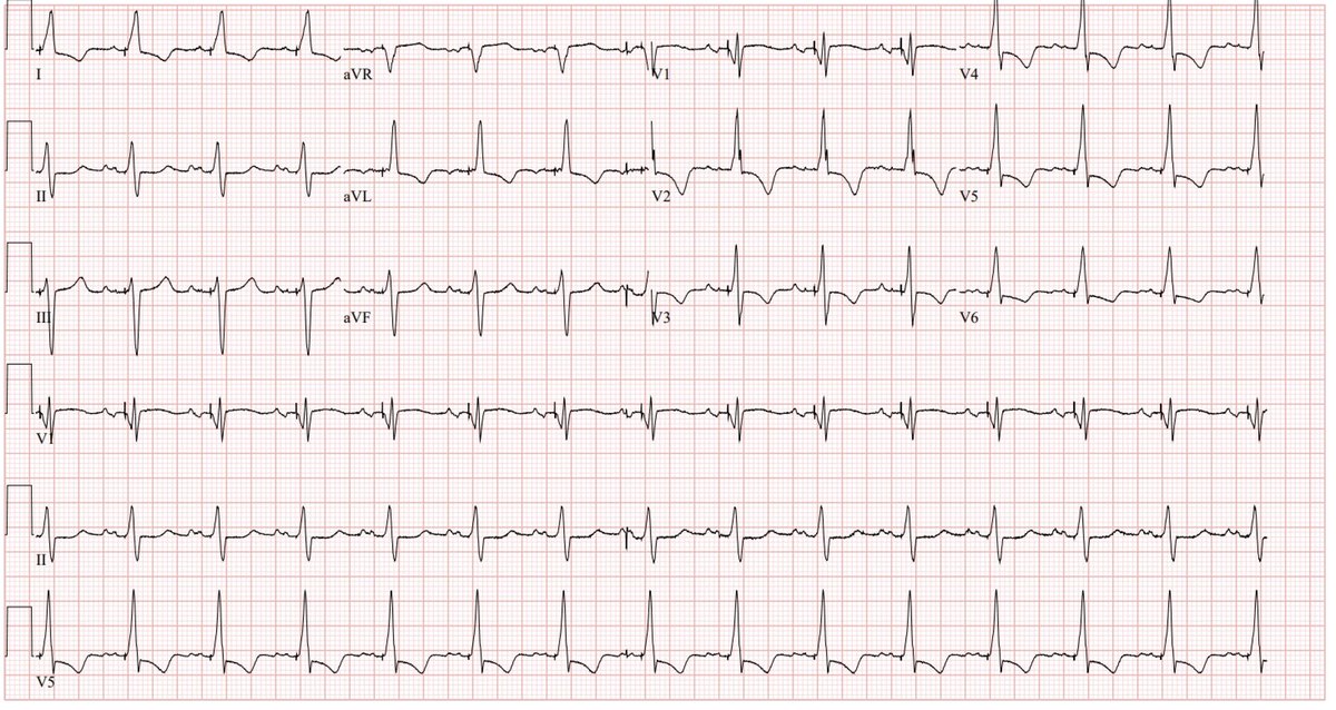 #EPeeps #dontdisthehis #conductionsystempacing #LBBpacing

EF0.40, near syncope and syncope