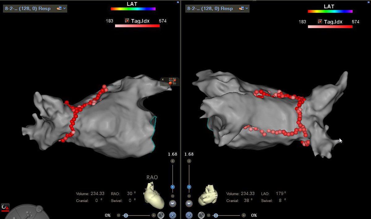 DrewHinojos1's tweet photo. #EPeeps Re-do AF case: right veins re-connected and then re-isolated. Induced and mapped a roof-dependent flutter. Terminated with blue lesion. Finished with a roof and posterior line. Thanks to @EPCARTOlogist @UsmanAta https://t.co/3sWWMMCbFy
