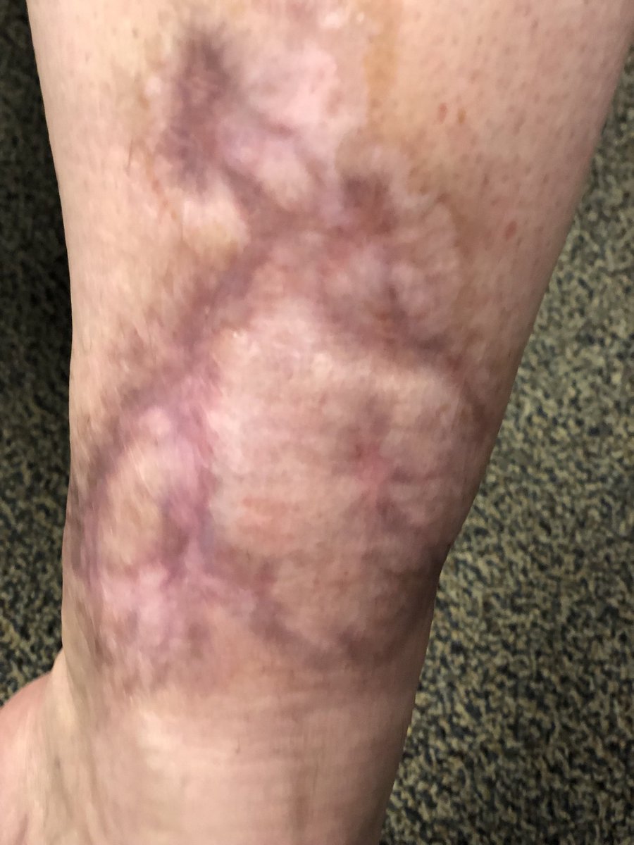 Janetbirdope's tweet photo. #ClinicalPearl Healed #pyoderma #gangrenosum. Rx was steroids + MTX + Azathioprine. https://t.co/wLmWIpJQ31