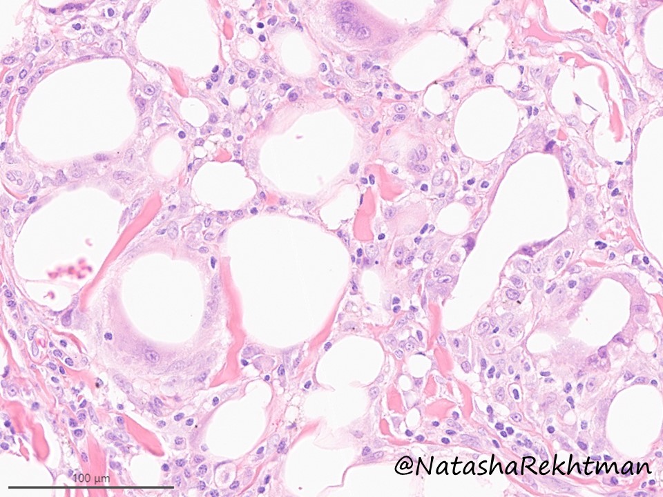 natasharekhtman's tweet photo. #PulmPath classic. For pathology trainees.
A striking example of … ❓
#PathTwitter #NatPathPuzzler @PulmPathSoc https://t.co/vV5APTUedB