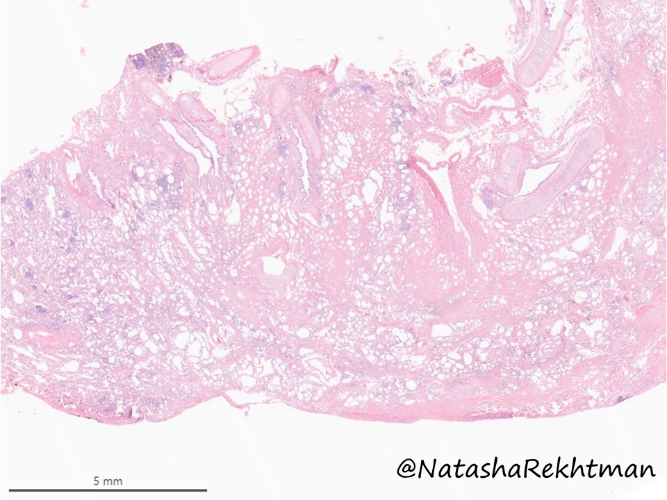 natasharekhtman's tweet photo. #PulmPath classic. For pathology trainees.
A striking example of … ❓
#PathTwitter #NatPathPuzzler @PulmPathSoc https://t.co/vV5APTUedB