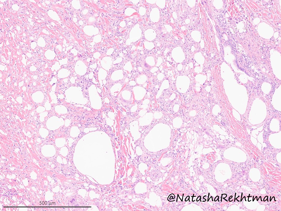 natasharekhtman's tweet photo. #PulmPath classic. For pathology trainees.
A striking example of … ❓
#PathTwitter #NatPathPuzzler @PulmPathSoc https://t.co/vV5APTUedB