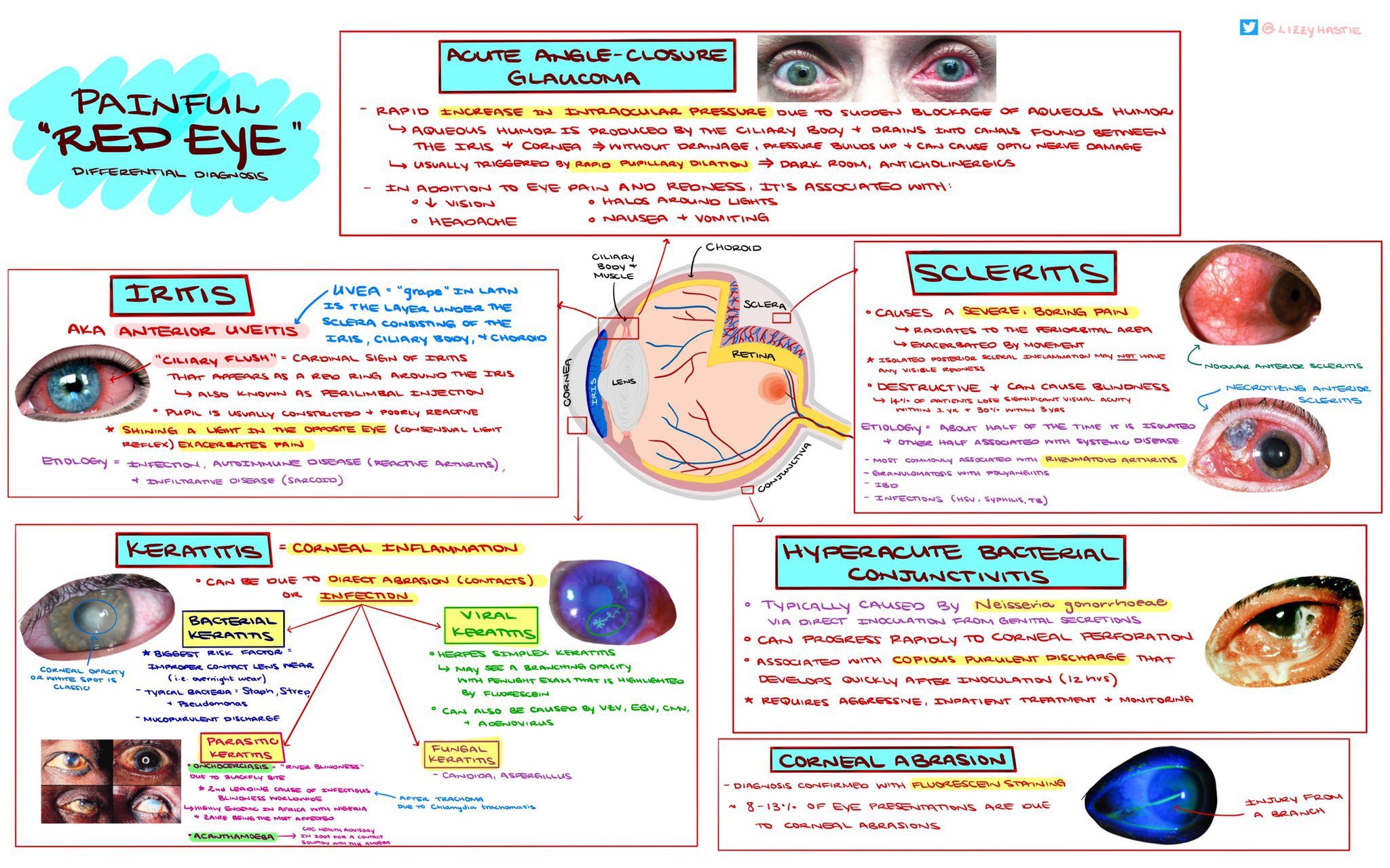 ميد MED💉🎓 on Twitter "Differential Diagnosis of Red Eye 👁🧐 . https
