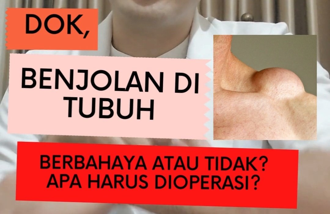 Haloo gess, jadi yg namanya BENJOLAN /tumor jinak pada tubuh itu kasusnya banyaaakk bgt, bs di tangan,kaki,punggung,dsb.

nah saya mau share dikit utk tmn2 yg ada benjolan di tubuhnya, berbahaya atau tidak?apa harus dioperasi?apa resikonya?
Marii kita bahas

- Thread santai -