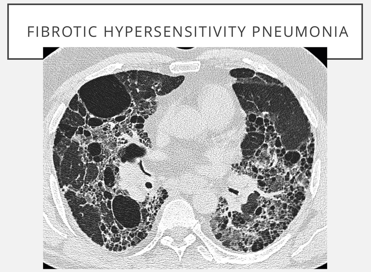 differential-diagnosis-of-cystic-lung-are-many-and-inconsistent
